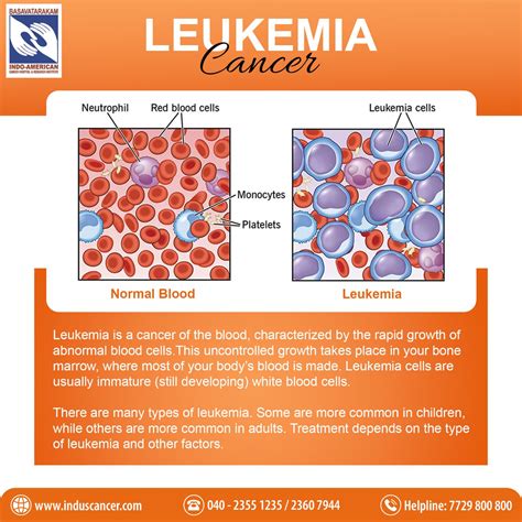 Leukemia Blood Cell Counts for Diagnosis, Treatment, and .